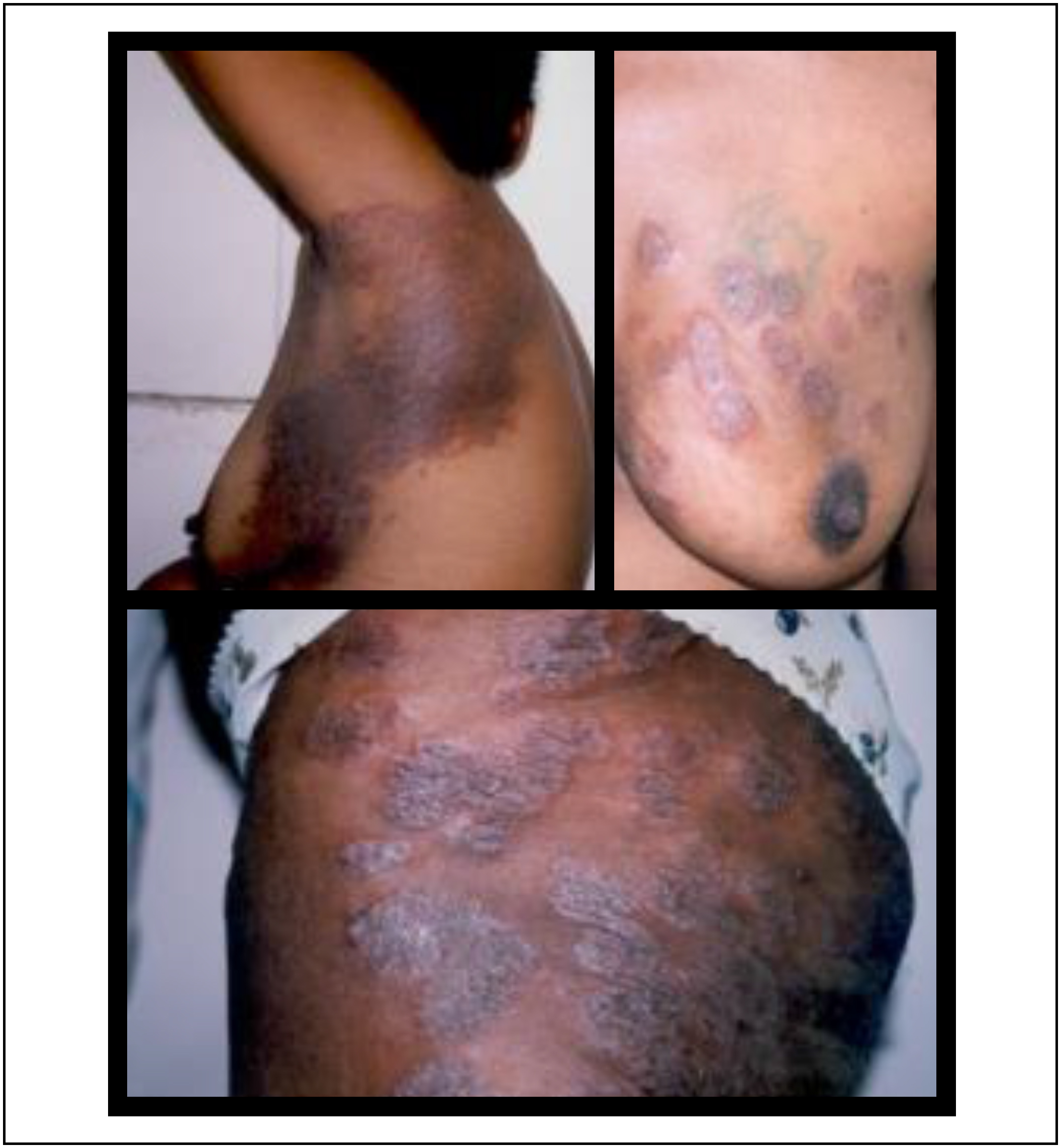 Disseminated dermatophytosis and acquired immunodeficiency  syndrome:literature review and presentation of clinical experience