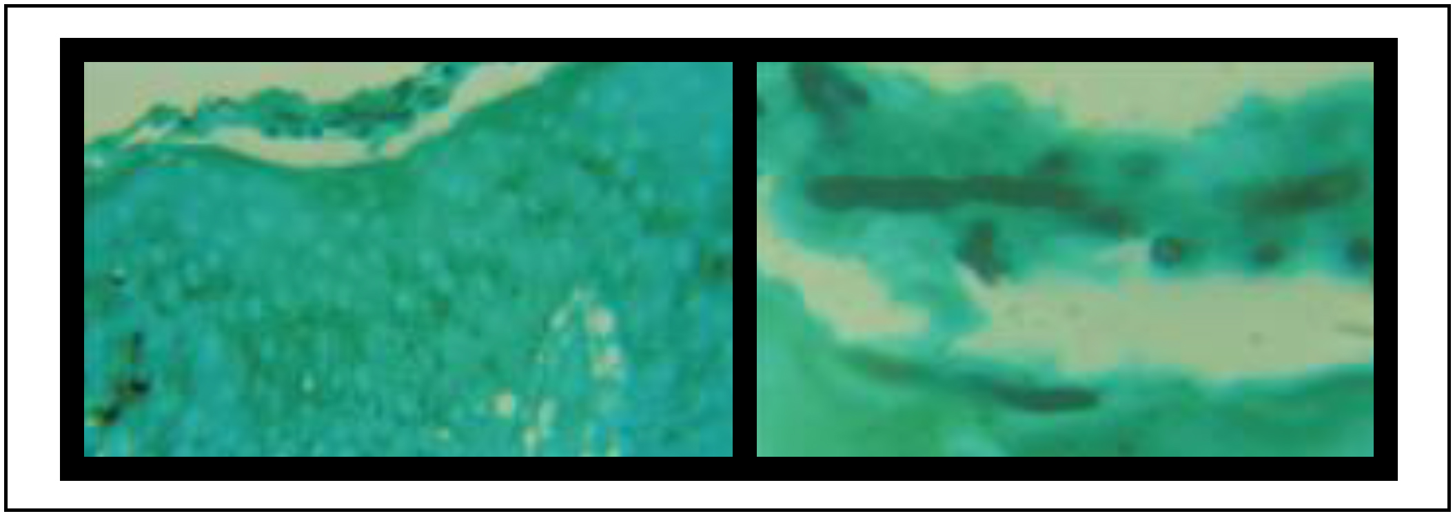 Cureus, Atypical Tinea Corporis Revealing a Human Immunodeficiency Virus  Infection